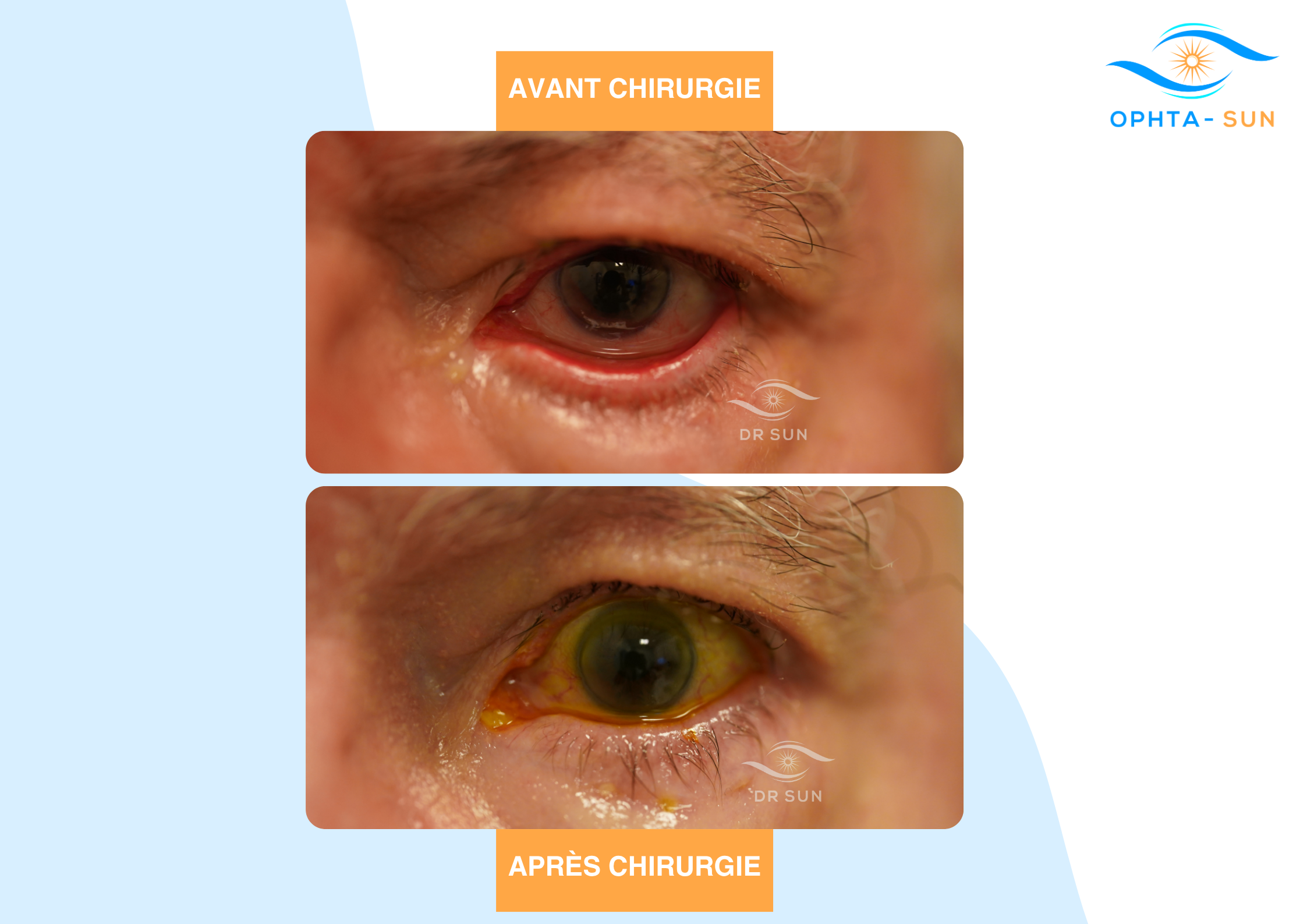 Ectropion avant après